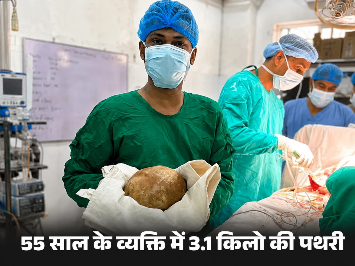 55 साल के व्यक्ति में 3.1 किलो की पथरी, 17 सेमी की ब्लैडर स्टोन कैसे बनी?